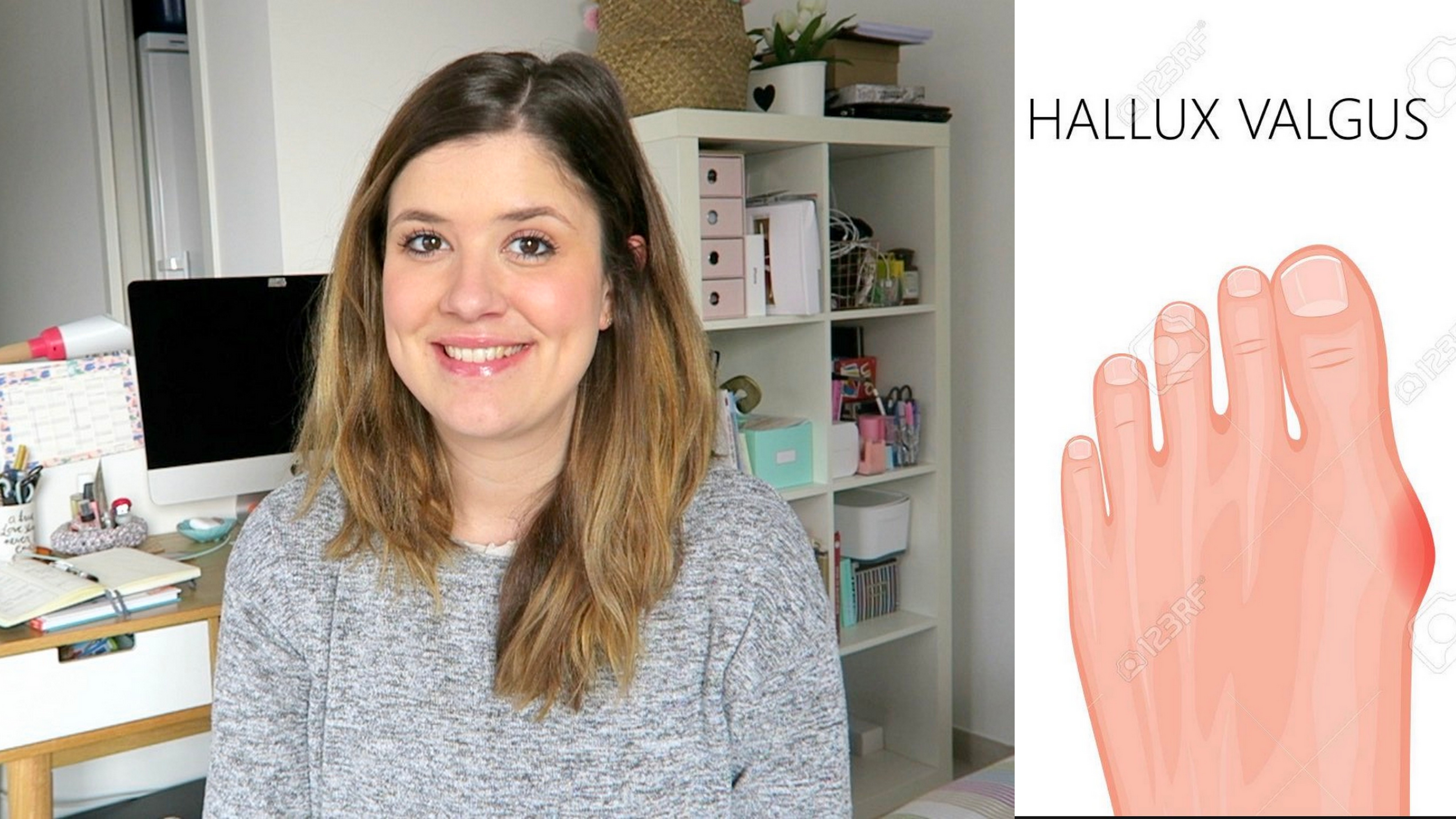 hallux-valgus-rigidus